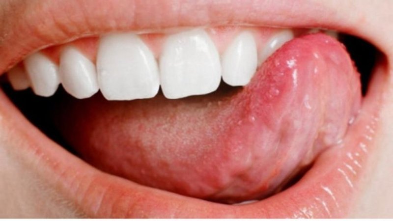 Dil yarasına ne iyi gelir, nasıl geçer? En etkili 7 öneri